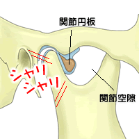 関節円板の変形が大きい場合