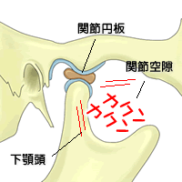 関節円板の変形が小さい場合