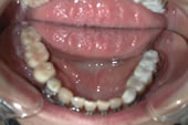 インプラントを利用して顎関節治療中の口腔内写真