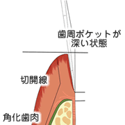 歯肉を切開します