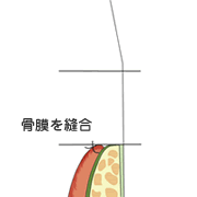 歯槽骨の頂上部分に歯肉を縫いつけます