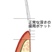 術後4～5ヵ月で、歯周ポケットの浅い健康的な歯肉の状態になります