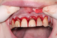 歯周病の外科療法による治療例 