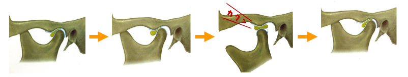 関節円盤前方転位の図