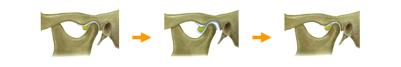 関節円盤の変形症の図